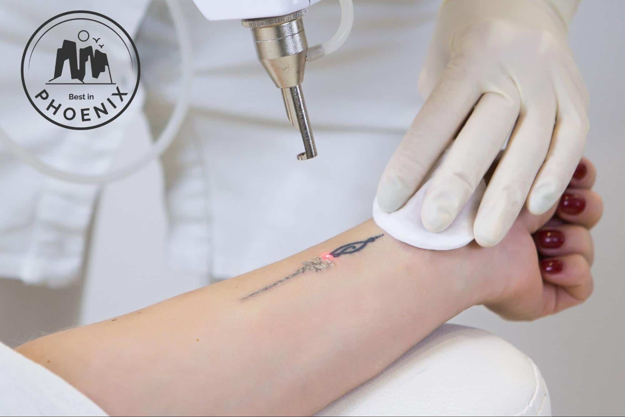 Tattoo Removal in Phoenix AZ  Eastside Microblading  Beauty