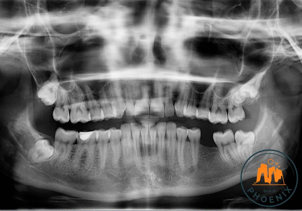 Top 5 Clinics For Wisdom Tooth Removal In Phoenix